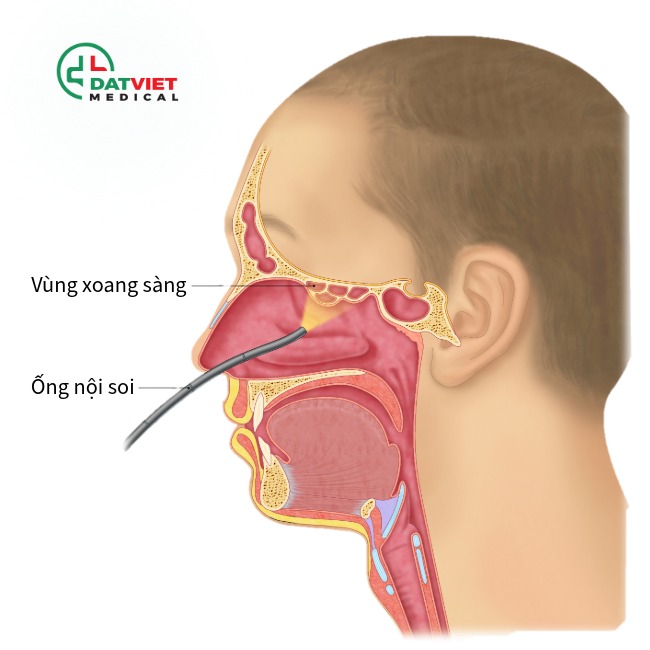 tìm hiểu nội soi tai mui họng